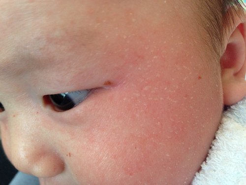乳児湿疹 乳児湿疹で皮膚科に行ったらステロイド処方で悪化 アコラボ ブログ Akolabo Blog