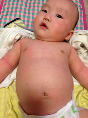 乳児湿疹 赤ちゃんやアトピーの人にオススメ 洗たく用せっけんシャボン玉スノール アコラボ ブログ Akolabo Blog